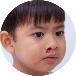 Chảy máu mũi